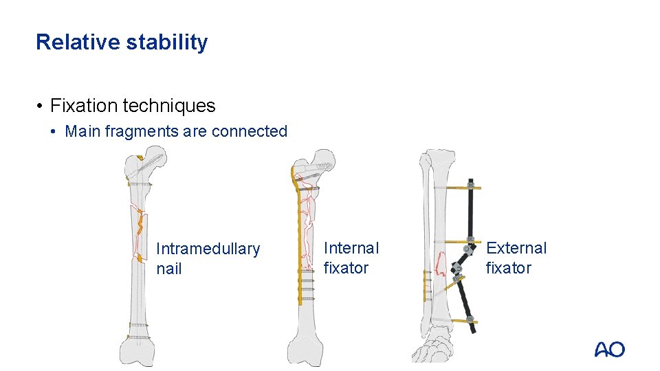 Relative stability • Fixation techniques • Main fragments are connected Intramedullary nail Internal fixator
