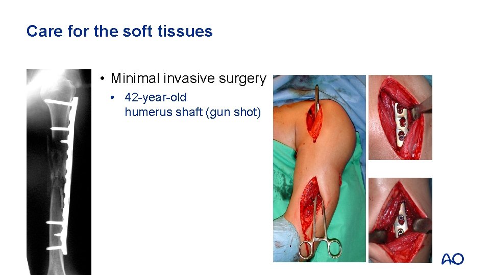 Care for the soft tissues • Minimal invasive surgery • 42 -year-old humerus shaft