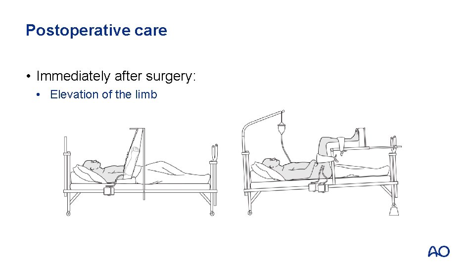 Postoperative care • Immediately after surgery: • Elevation of the limb 