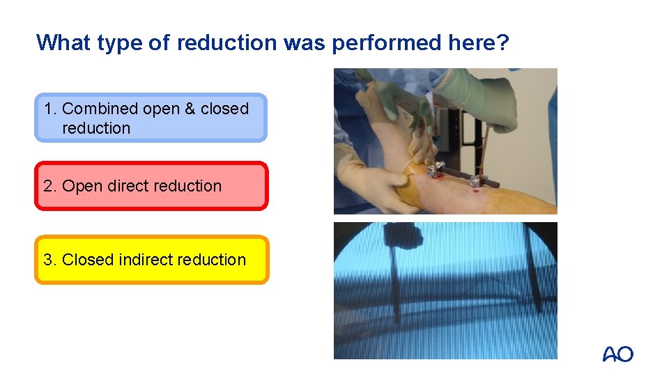 What type of reduction was performed here? 1. Combined open & closed reduction 2.