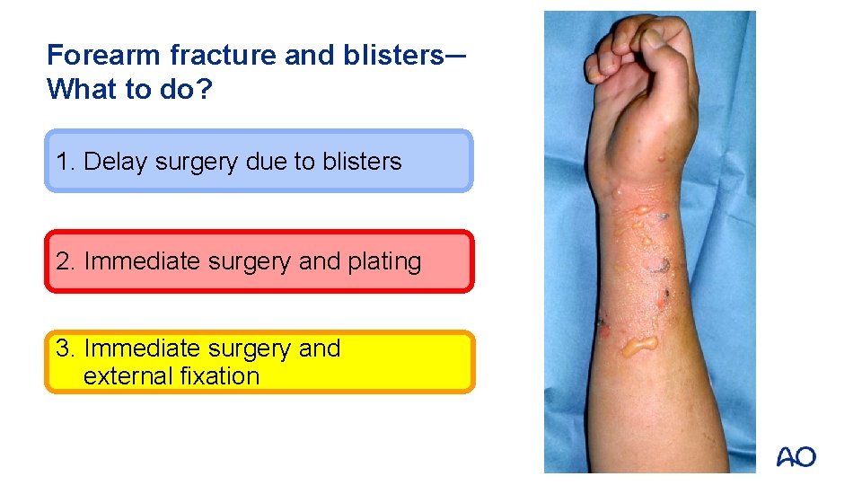 Forearm fracture and blisters─ What to do? 1. Delay surgery due to blisters 2.