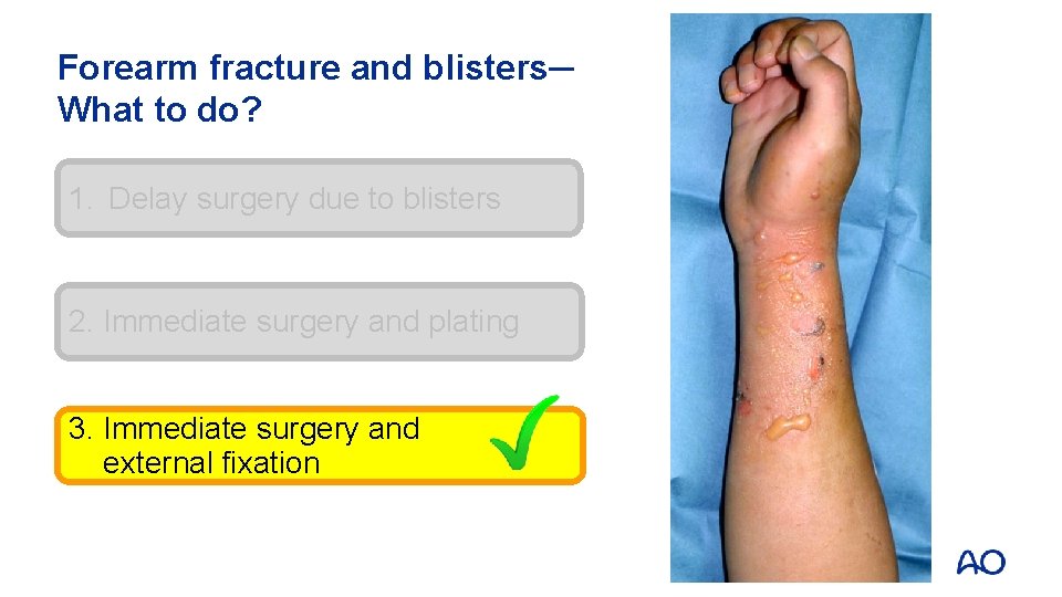 Forearm fracture and blisters─ What to do? 1. Delay surgery due to blisters 2.