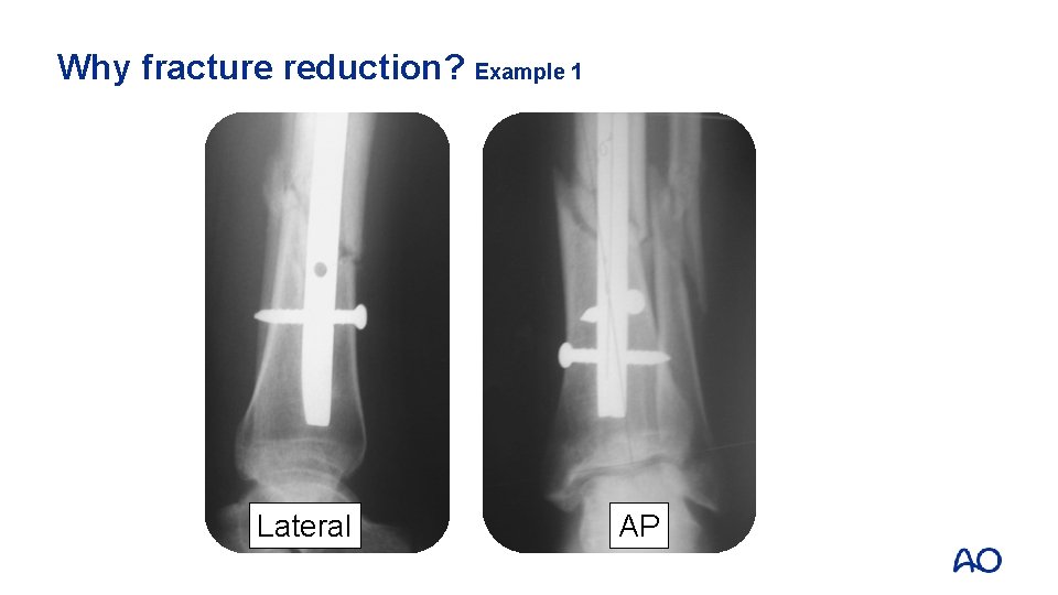 Why fracture reduction? Example 1 Lateral AP 