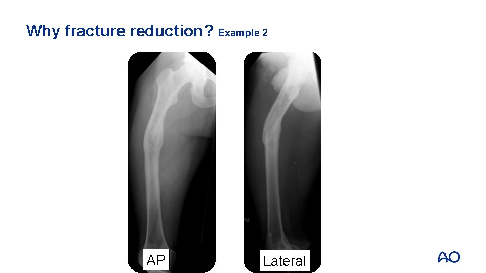 Why fracture reduction? Example 2 AP Lateral 