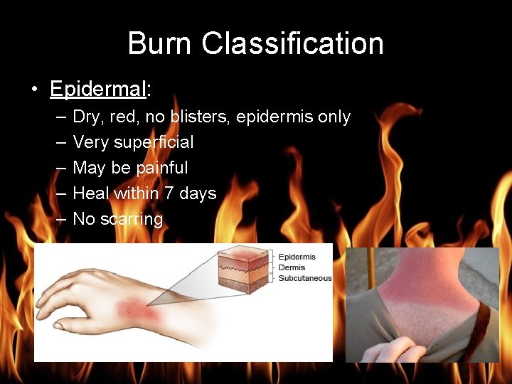 Burn Management Burn Classification • Epidermal: – – – Dry, red, no blisters, epidermis