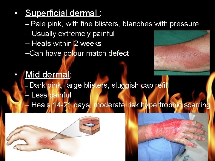 Burn Management • Superficial dermal : – Pale pink, with fine blisters, blanches with