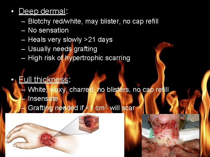 Burn Management • Deep dermal: – – – Blotchy red/white, may blister, no cap