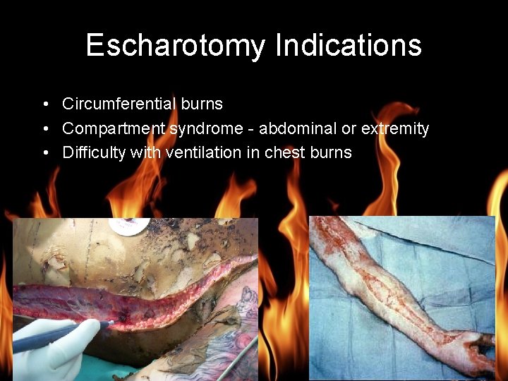 Burn Management Escharotomy Indications • Circumferential burns • Compartment syndrome - abdominal or extremity