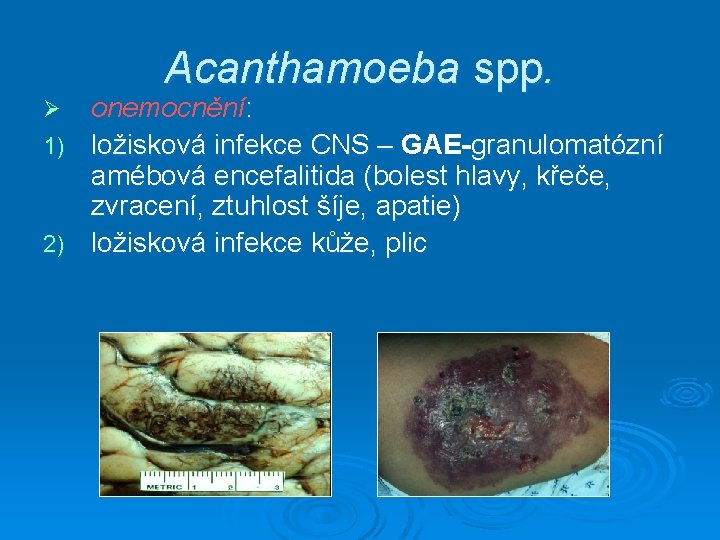 Acanthamoeba spp. onemocnění: 1) ložisková infekce CNS – GAE-granulomatózní amébová encefalitida (bolest hlavy, křeče,