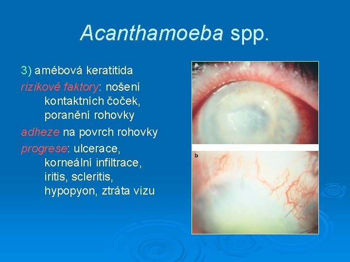 Acanthamoeba spp. 3) amébová keratitida rizikové faktory: nošení kontaktních čoček, poranění rohovky adheze na