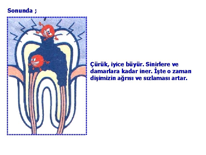 Sonunda ; Çürük, iyice büyür. Sinirlere ve damarlara kadar iner. İşte o zaman dişimizin