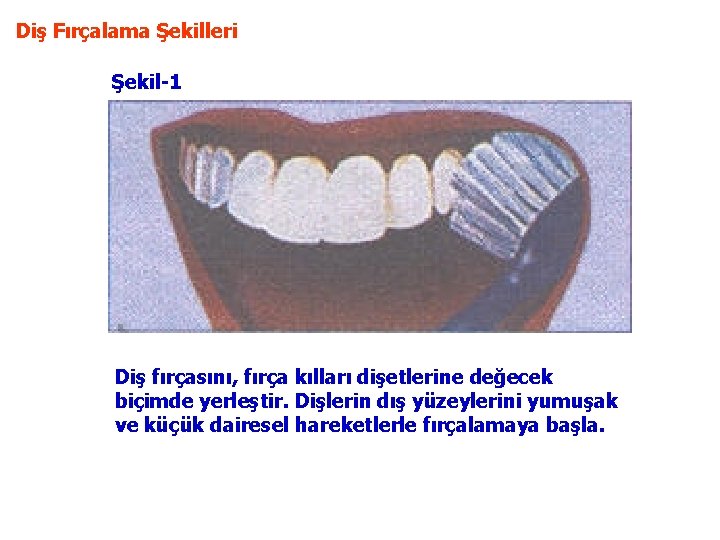 Diş Fırçalama Şekilleri Şekil-1 Diş fırçasını, fırça kılları dişetlerine değecek biçimde yerleştir. Dişlerin dış