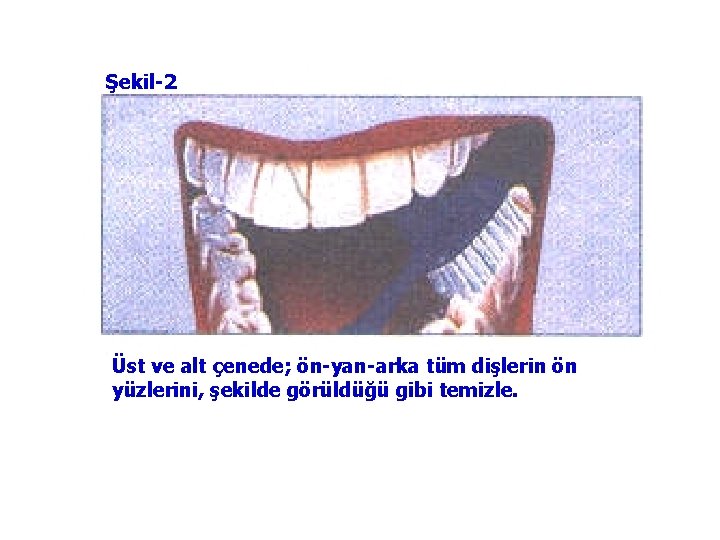 Şekil-2 Üst ve alt çenede; ön-yan-arka tüm dişlerin ön yüzlerini, şekilde görüldüğü gibi temizle.