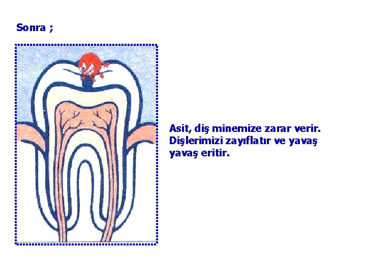 Sonra ; Asit, diş minemize zarar verir. Dişlerimizi zayıflatır ve yavaş eritir. 
