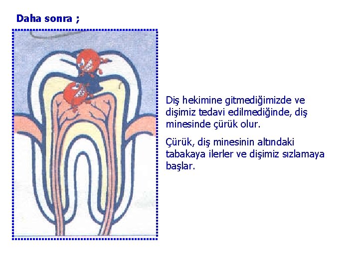 Daha sonra ; Diş hekimine gitmediğimizde ve dişimiz tedavi edilmediğinde, diş minesinde çürük olur.