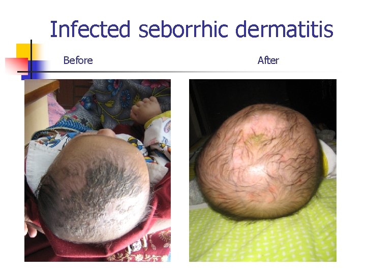 Infected seborrhic dermatitis Before After 