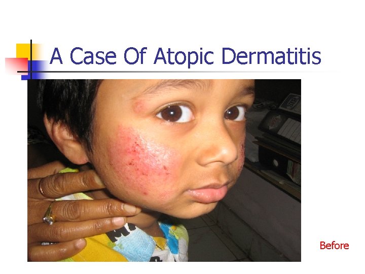 A Case Of Atopic Dermatitis Before 