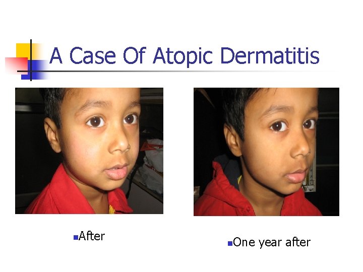 A Case Of Atopic Dermatitis n After n One year after 
