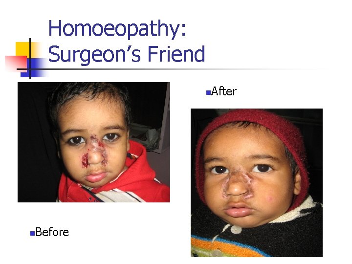 Homoeopathy: Surgeon’s Friend n n Before After 