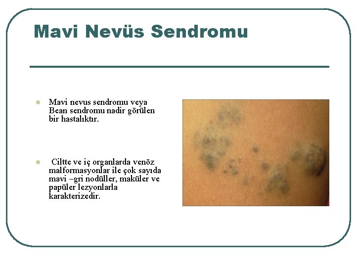 Mavi Nevüs Sendromu l Mavi nevus sendromu veya Bean sendromu nadir görülen bir hastalıktır.