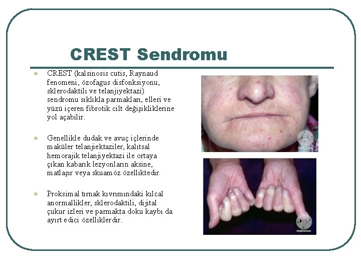 CREST Sendromu l CREST (kalsinosis cutis, Raynaud fenomeni, özofagus disfonksiyonu, sklerodaktili ve telanjiyektazi) sendromu