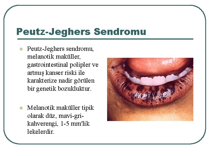 Peutz-Jeghers Sendromu l Peutz-Jeghers sendromu, melanotik maküller, gastrointestinal polipler ve artmış kanser riski ile