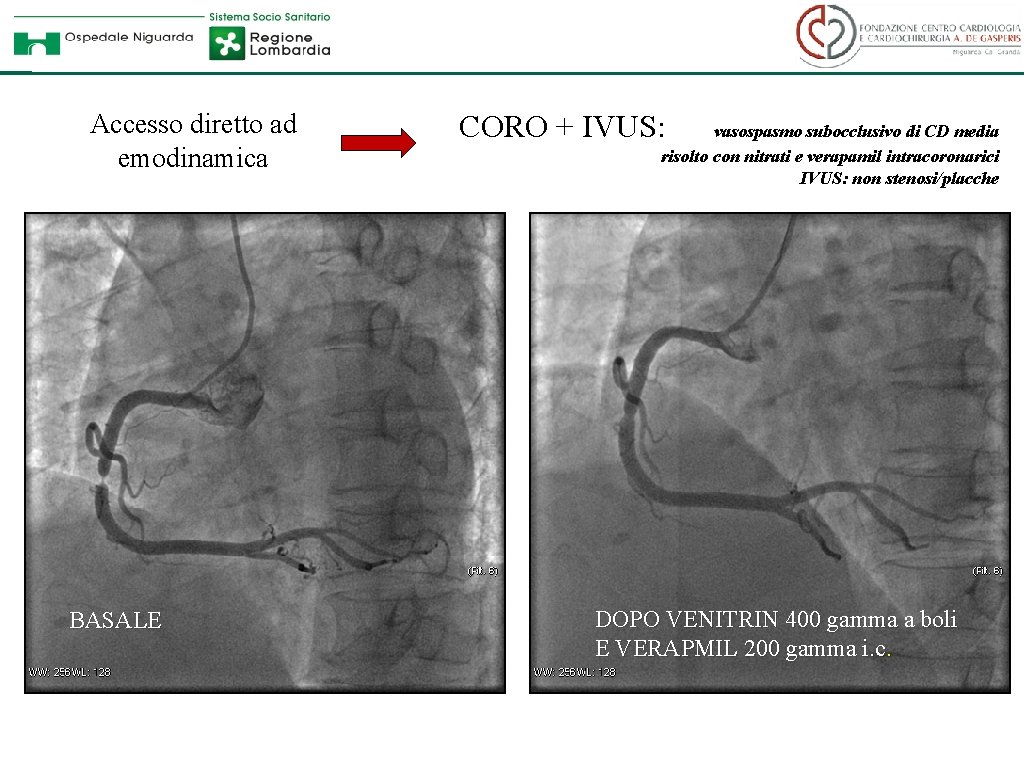 Accesso diretto ad emodinamica BASALE CORO + IVUS: vasospasmo subocclusivo di CD media risolto