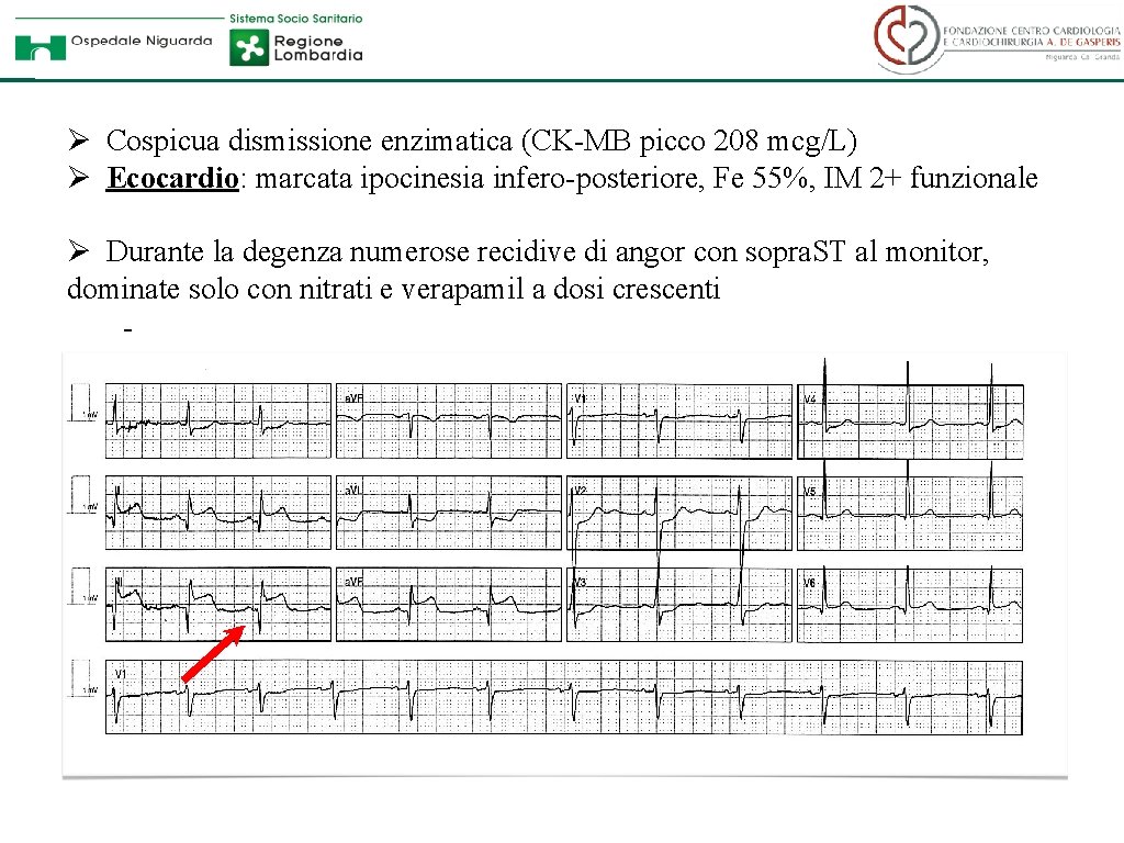 Ø Cospicua dismissione enzimatica (CK-MB picco 208 mcg/L) Ø Ecocardio: marcata ipocinesia infero-posteriore, Fe