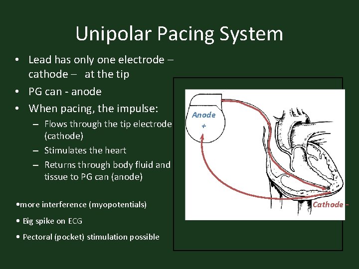 Unipolar Pacing System • Lead has only one electrode – cathode – at the