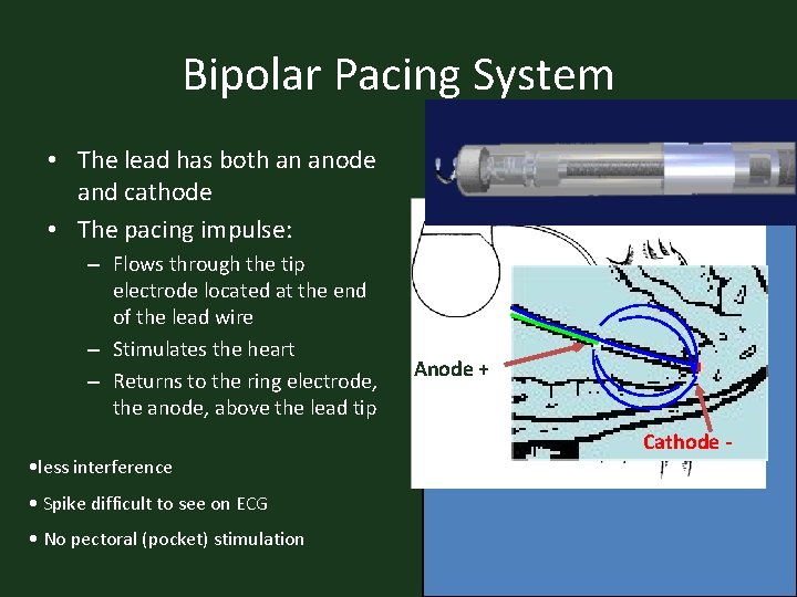 Bipolar Pacing System • The lead has both an anode and cathode • The