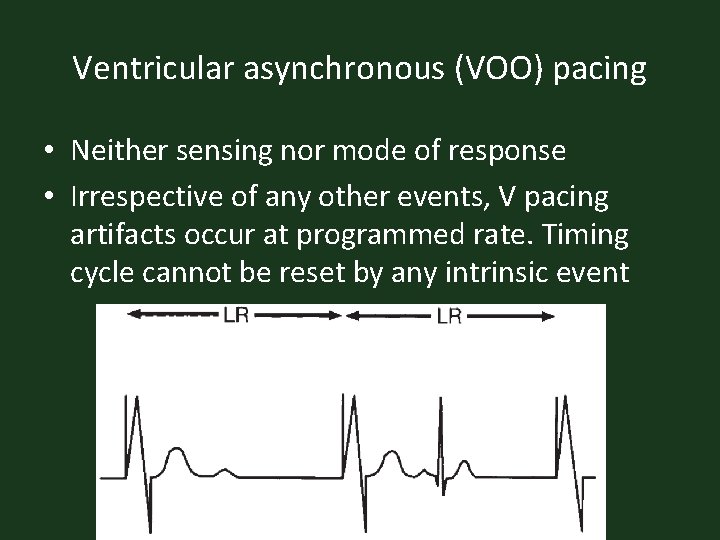 Ventricular asynchronous (VOO) pacing • Neither sensing nor mode of response • Irrespective of