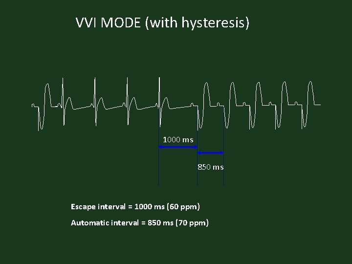 VVI MODE (with hysteresis) 1000 ms 850 ms Escape interval = 1000 ms (60