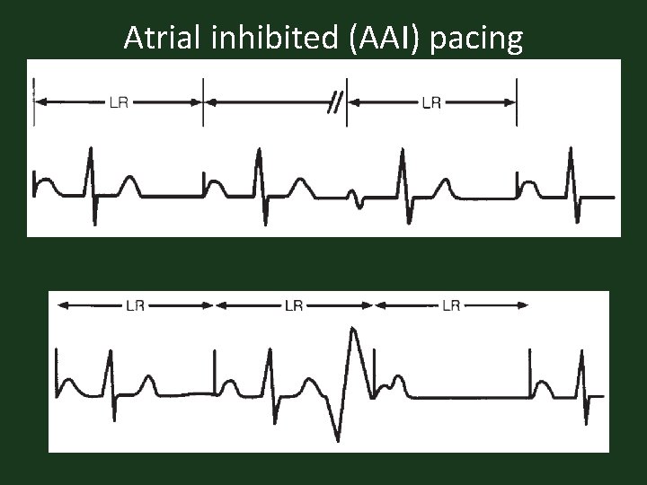 Atrial inhibited (AAI) pacing 