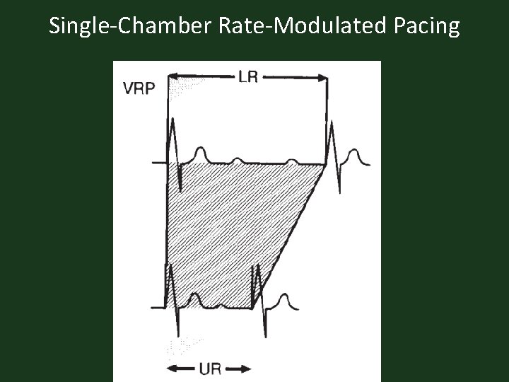 Single-Chamber Rate-Modulated Pacing 