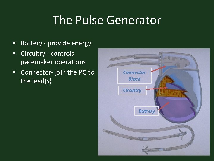 The Pulse Generator • Battery - provide energy • Circuitry - controls pacemaker operations