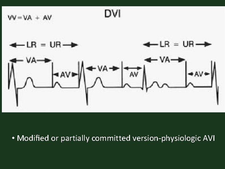  • Modiﬁed or partially committed version-physiologic AVI 