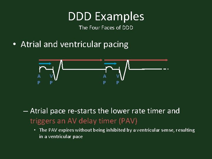 DDD Examples The Four Faces of DDD • Atrial and ventricular pacing A P