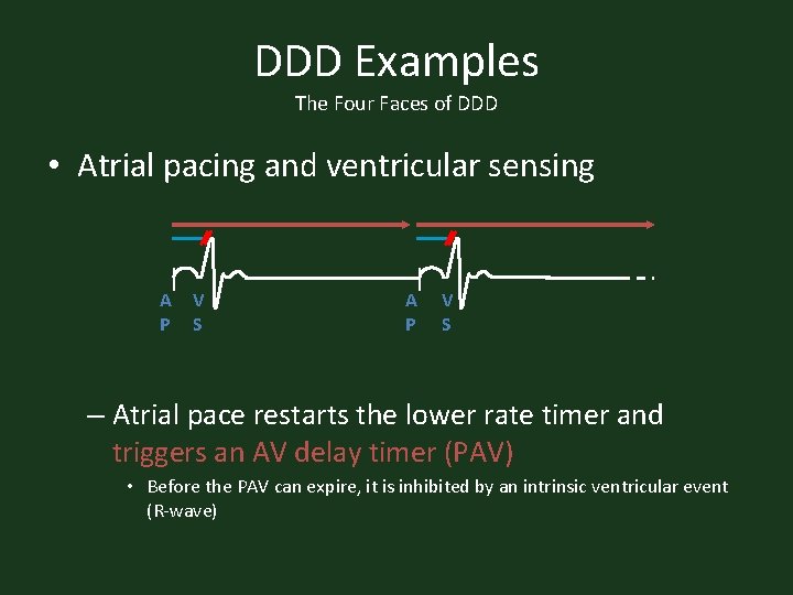 DDD Examples The Four Faces of DDD • Atrial pacing and ventricular sensing A