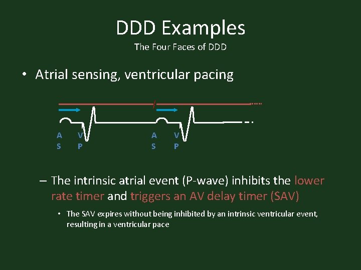 DDD Examples The Four Faces of DDD • Atrial sensing, ventricular pacing A S
