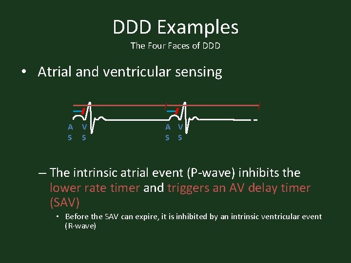 DDD Examples The Four Faces of DDD • Atrial and ventricular sensing A V