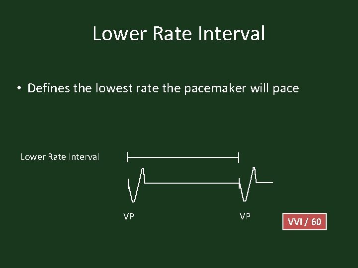 Lower Rate Interval • Defines the lowest rate the pacemaker will pace Lower Rate