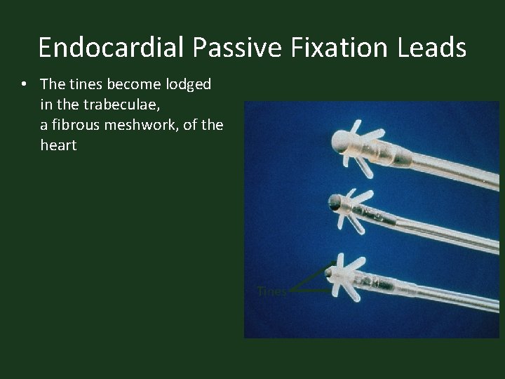 Endocardial Passive Fixation Leads • The tines become lodged in the trabeculae, a fibrous
