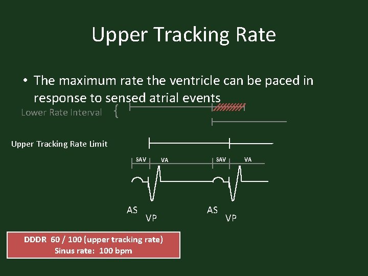 Upper Tracking Rate • The maximum rate the ventricle can be paced in response