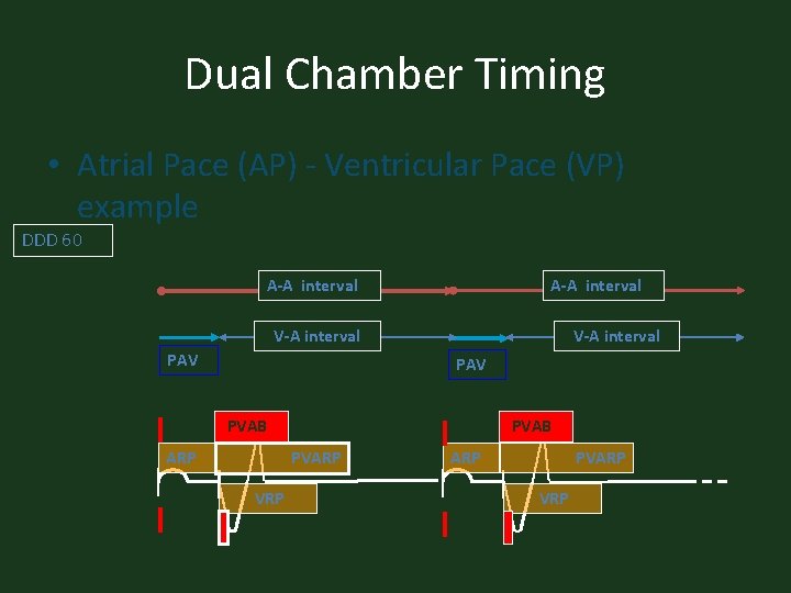 Dual Chamber Timing • Atrial Pace (AP) - Ventricular Pace (VP) example DDD 60