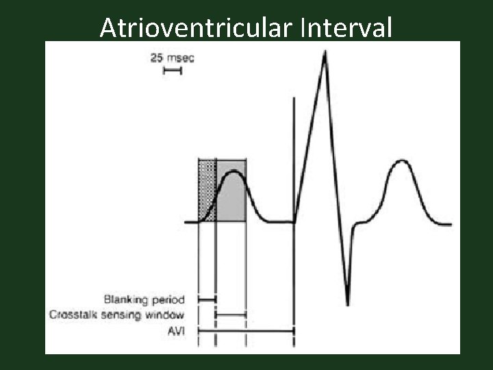 Atrioventricular Interval 