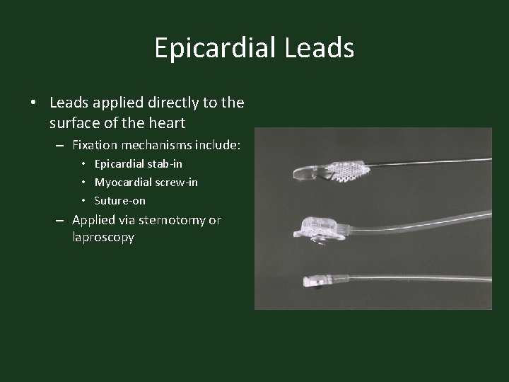 Epicardial Leads • Leads applied directly to the surface of the heart – Fixation