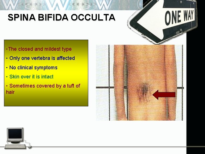 SPINA BIFIDA OCCULTA • The closed and mildest type • Only one vertebra is