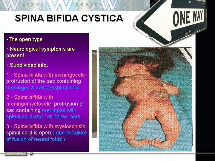 SPINA BIFIDA CYSTICA • The open type • Neurological symptoms are present • Subdivided