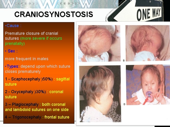 CRANIOSYNOSTOSIS • Cause : Premature closure of cranial sutures (more severe if occurs prenatally)