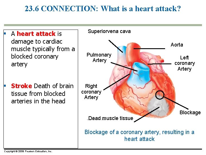 23. 6 CONNECTION: What is a heart attack? § A heart attack is damage
